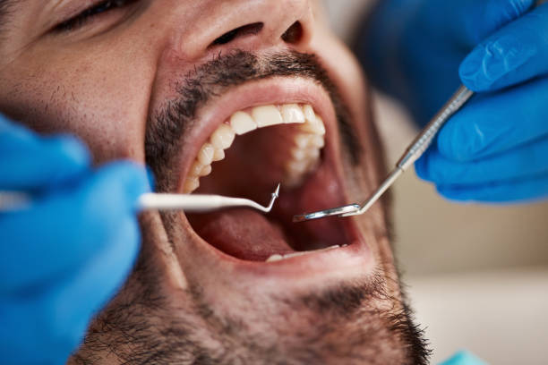 Best Emergency Dentist for Lost Fillings or Crowns in Vincent, CA